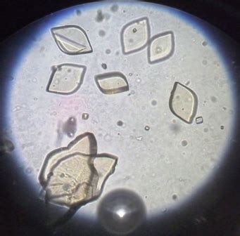 [Figure, Uric acid Crystals in Urine...] - StatPearls - NCBI Bookshelf