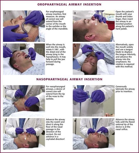 Nasopharyngeal Airway Measurement