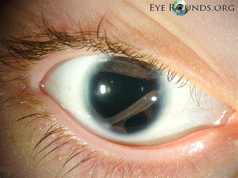 Axenfeld-Rieger syndrome : The University of Iowa, Ophthalmology