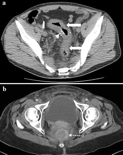 a A 42-year-old man with signet-ring cell carcinoma in the high rectum... | Download Scientific ...