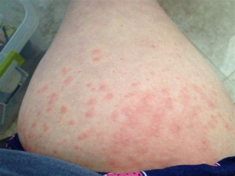 Pruritic Urticarial Papules and Plaques of Pregnancy (PUPPP Rash)