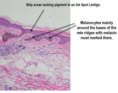 Dermoscopy Made Simple: Ink Spot Lentigo