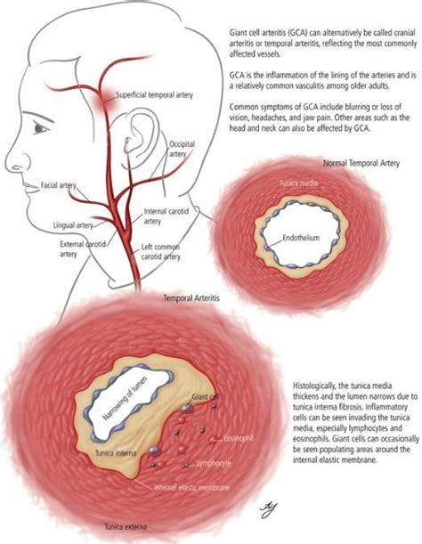 Pin on Polymyalgia Rheumatica