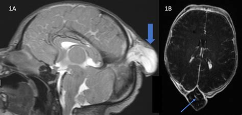 Parietal Encephalocele With Fenestrated Superior Sagittal Sinus and ...