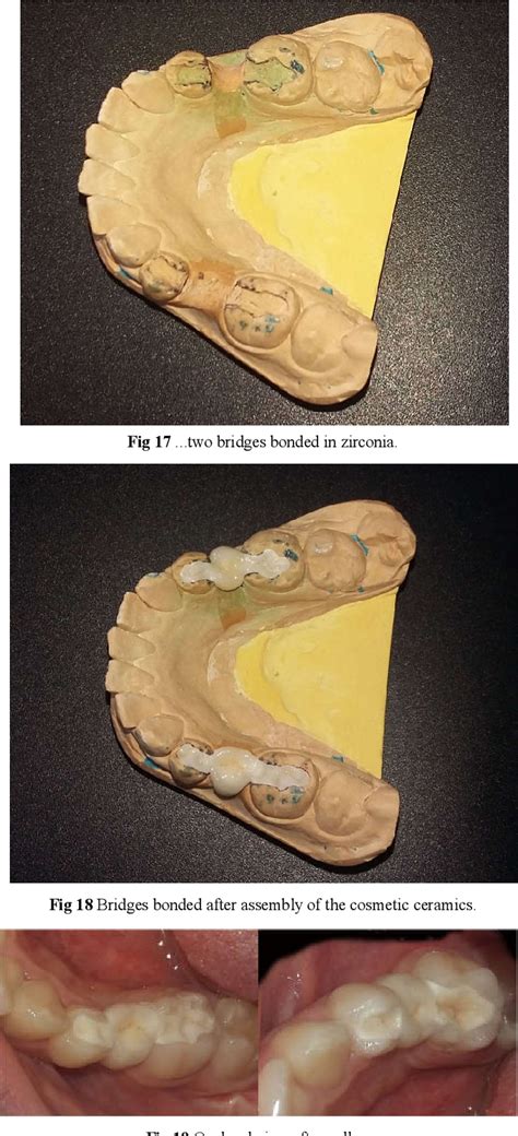 Figure 3 from BONDED BRIDGE ... WHAT EVOLUTION ? | Semantic Scholar