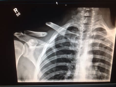 Recently crashed... Here is how my fractured clavicle (collarbone) looks like in X-Ray : motorcycles