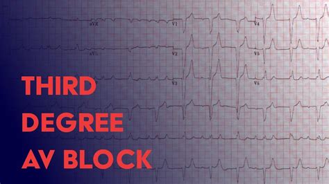 Third Degree (Complete) Heart Block - EKG (ECG) Interpretation - YouTube
