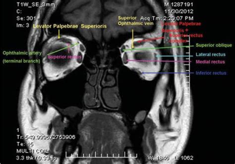 Orbit MRI Anatomy | Radiology Anatomy Images