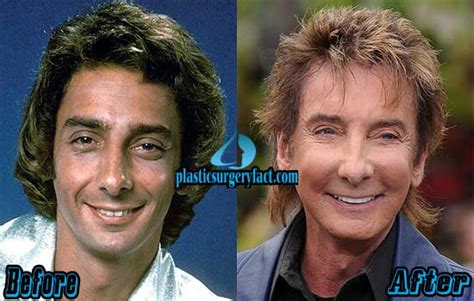 Barry Manilow Plastic Surgery Before and After Photos - Plastic Surgery ...