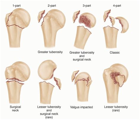 Open Reduction and Internal Fixation of Proximal Humerus Fractures ...