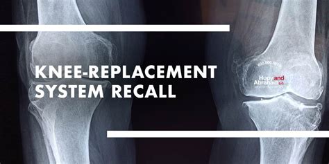 DePuy Attune® Knee Replacement System Recall and Complications | Hupy ...