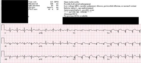 Dr. Smith's ECG Blog: Anterorlateral STEMI? Old Anterior MI? But cath shows RCA thrombotic stenosis.