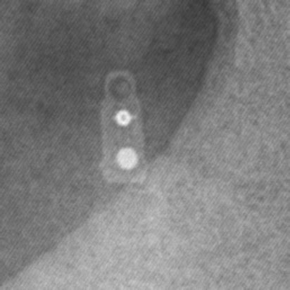 CSF shunt valves - x-ray appearance and documents