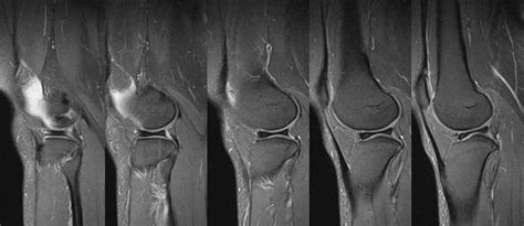 Discoid Meniscus | The Third Eye - Radiology site