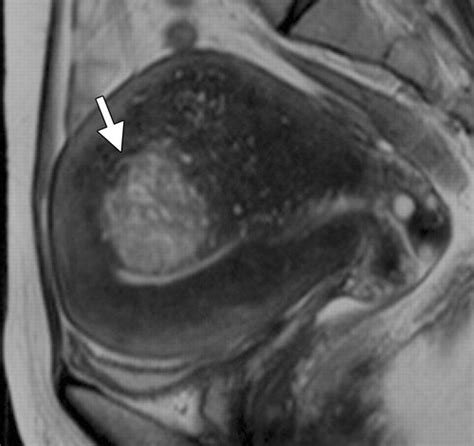 Adenomyosis: Usual and Unusual Imaging Manifestations, Pitfalls, and ...