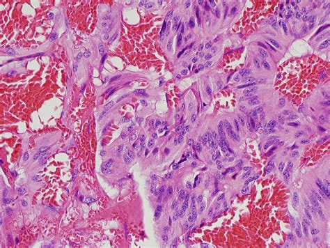 Pathology Outlines - Paraganglioma