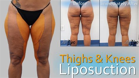 Lipo 360 Legs | Thigh & Knee Liposuction | Lipedema Surgery | Expert Dr. Thomas Su - YouTube