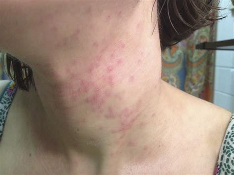 My journey with itchy skin.: Remember that one time: Eczema Herpeticum