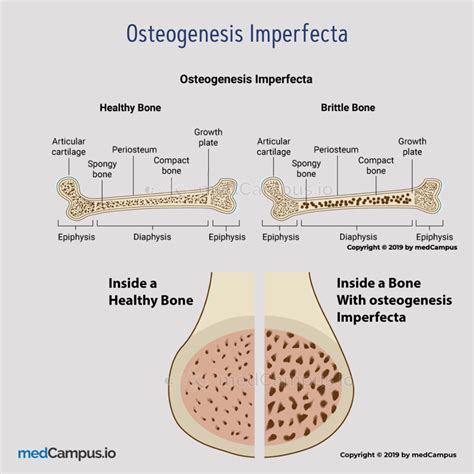 Osteogenesis imperfecta (OI) - Orthopaedics - www.MedicalTalk.Net the ...