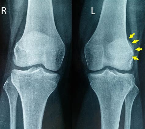 Isolated Avulsion Fracture of Patellar Attachment of Medial ...