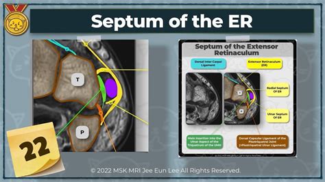 [Anatomy_22] Septum of the Extensor Retinaculum, wrist MRI - YouTube