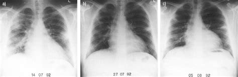 Coxiella burnetii pneumonia | European Respiratory Society