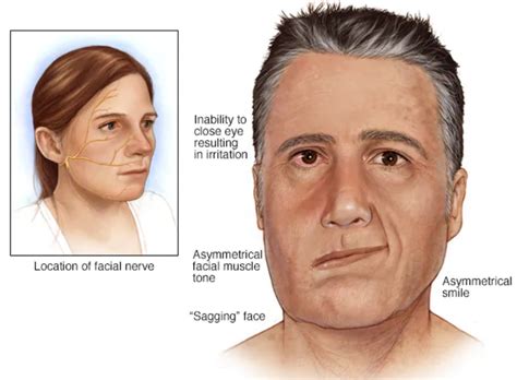 Facial Paralysis Causes & Treatment | MD. Burak Sercan Erçin