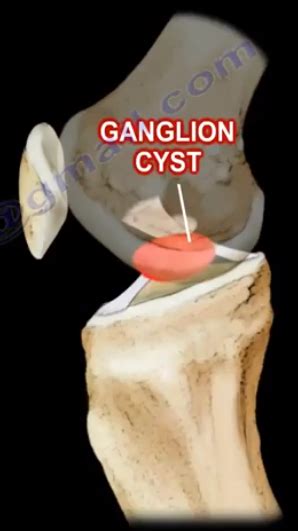 Ganglion Cyst Around the Knee. Ganglion cyst of the cruciates can… | by ...