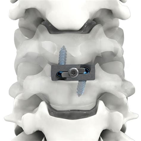 Cervical Interbody Fusion Cage Acis Depuy Synthes Anterior | My XXX Hot ...