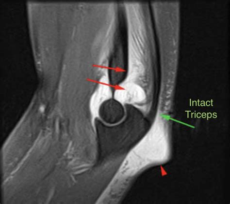 Triceps Tendon Tears – Dr. Edward Weldon