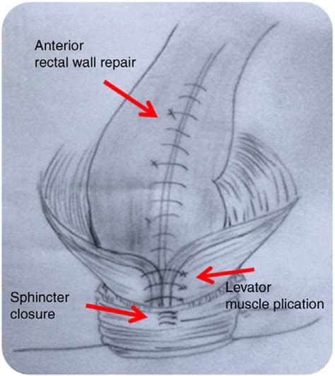 -Plication of the levator muscles. | Download Scientific Diagram