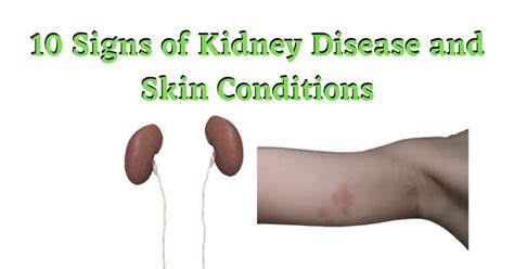 10 Signs Of Kidney Disease And Skin Conditions – Turn To Be Healthy