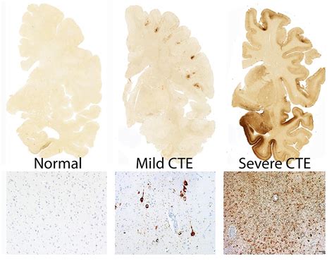 BU Researchers Find CTE in 99% of Former NFL Players Studied | Bostonia ...