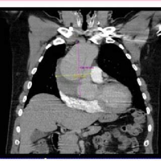 Pre-OP CT-Scan: Axial: Ascending and descending aorta. | Download Scientific Diagram