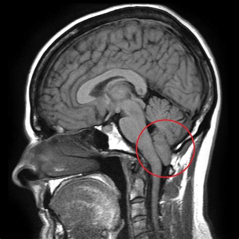 Chiari Malformations | Neurosurgery | Geeky Medics