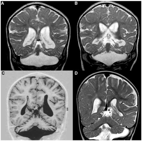 Examples of MRI scores of cerebellum. (A and B) Cerebellar hemisphere ...