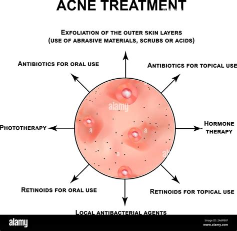 Acne treatment. Pustules, papules, comedones, blackheads, acne on the ...