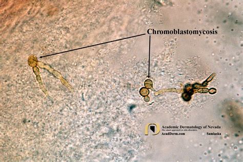 Chromoblastomycosis (CBM): Chromomycosis... - Academic Dermatology of Nevada