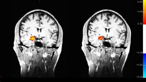 Scientists studied how it seems to change the brain in depressed patients