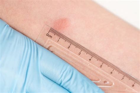 Difference Between Positive TB Skin Test and Negative TB Skin Test ...