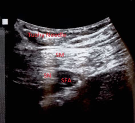 Ultrasound image demonstrating placement for the adductor canal ...