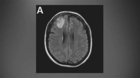 Neurosurgeon plucks live worm from woman's brain after months of ...