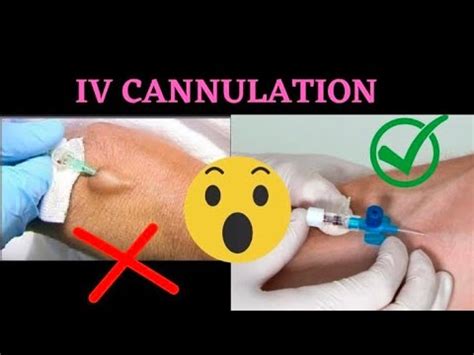 IV Cannulation Technique | Procedure |Intravenous(IV) Cannula Insertion ...