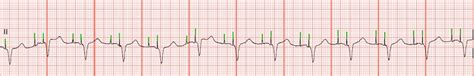 EKG Rhythm Strip Quiz 21