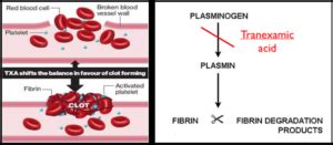 TRANEXAMIC ACID (TXA) – St. Joseph's Health Center: Emergency Medicine ...