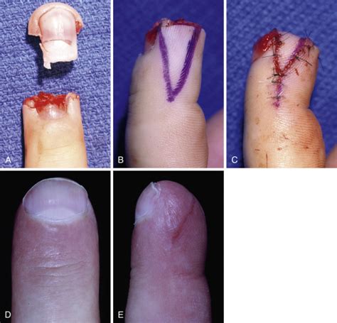 Perionychium | Musculoskeletal Key