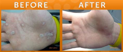 Laser Treatment for Warts in New Jersey | SOMA Skin & Laser