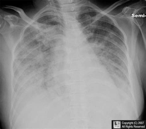 Pulmonary Edema; Wet Lung