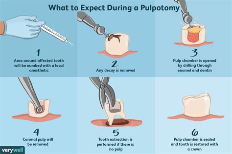 Pulpotomy: Uses, Side Effects, and Procedure