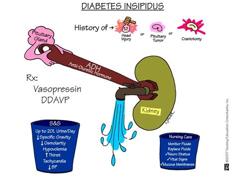 Diabetes Insipidus-ABC Medicine